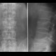 Compression fracture of lumbar vertebra: X-ray - Plain radiograph